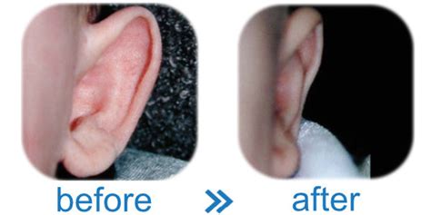 how to make ears not stick out