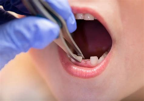 How To Numb A Tooth To Pull It Out