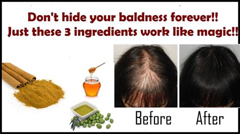 How To Overcome Female Pattern Baldness Naturally