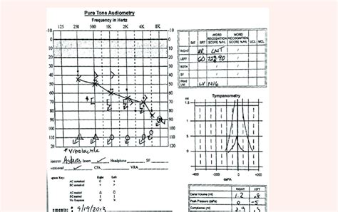 How To Perform A Tympanogram