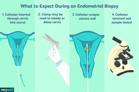 how to perform endometrial biopsy