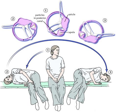 how to perform the epley maneuver video