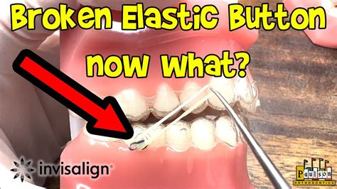 How To Place Buttons For Invisalign