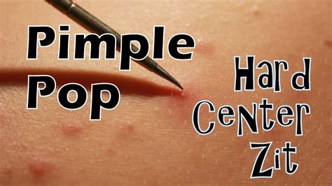 How To Pop A Zit Easily