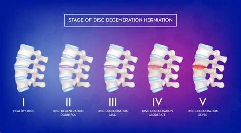 How To Prevent Disc Desiccation
