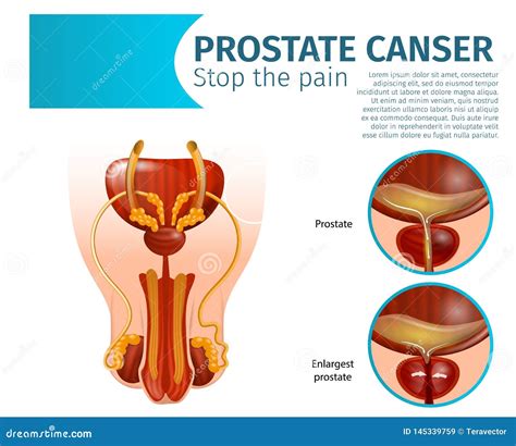 How To Prevent Inflamed Prostate