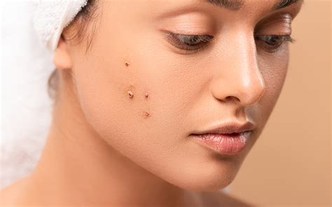 how to properly use a pimple patch