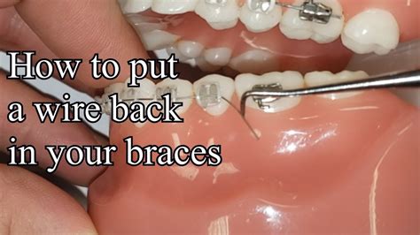 How To Put Braces Bracket Back On