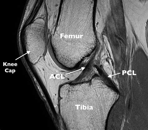 how to read mri for acl tear