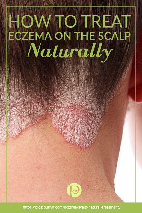 How To Reduce Eczema On Scalp  A Comprehensive Guide