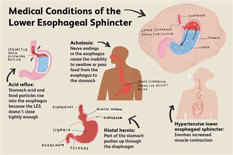 how to reduce esophagus inflammation