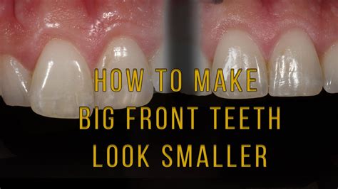 How To Reduce Teeth Size