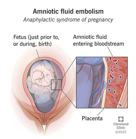 How To Refill Amniotic Fluid