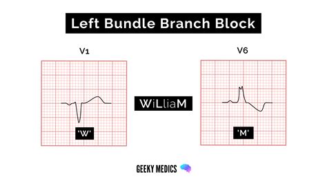 how to remember left and right bundle branch block