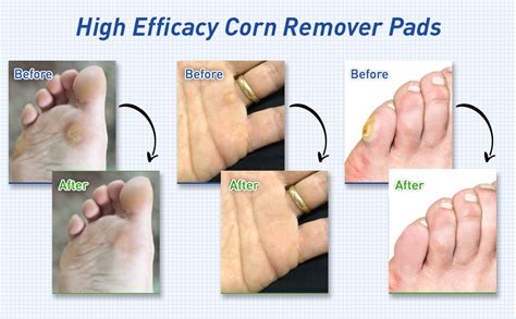 How To Remove A Corn After Using Corn Pads