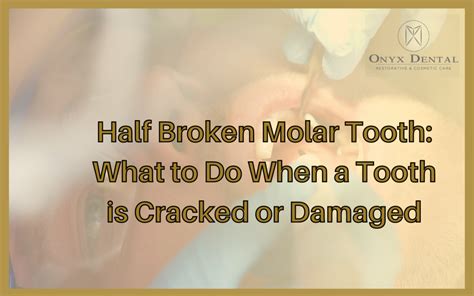 How To Remove A Half Broken Tooth