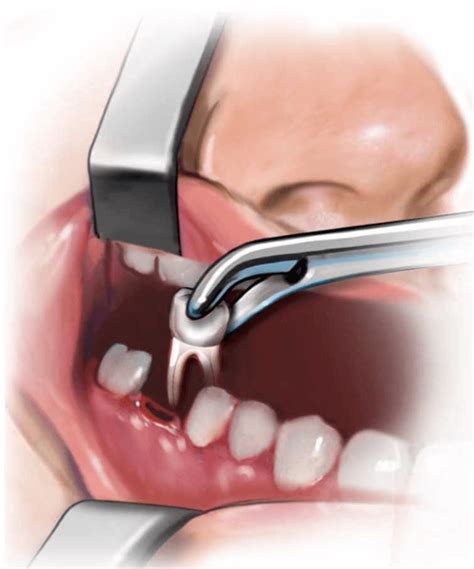 How To Remove A Tooth From A Child