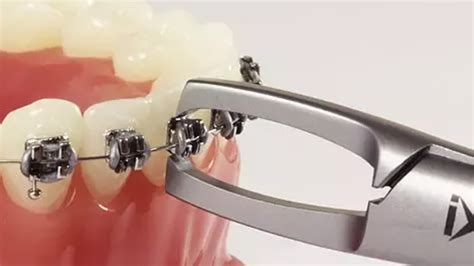 How To Remove Bracket From Wire