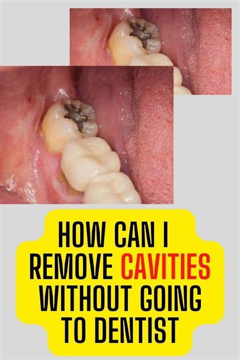 8 Simple Ways to Naturally Reverse Cavities and Heal Tooth Decay