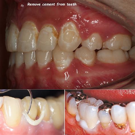 How To Remove Cement From Your Teeth