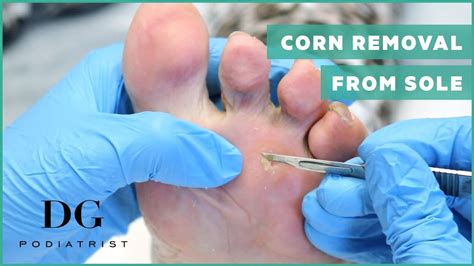 How To Remove Corn From Small Toe