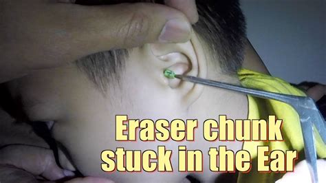 How To Remove Eraser From Ear