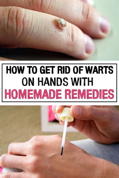 how to remove flat warts