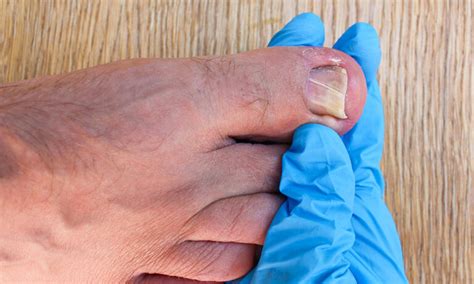 Say Goodbye to Pain: A Step-by-Step Guide on How to Remove Ingrown Nail Safely and Effectively