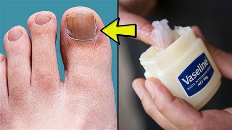 Say Goodbye to Fungal Infections: A Step-by-Step Guide on How to Remove Nail Fungus Effectively