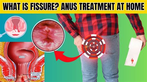 how to remove object from anus at home