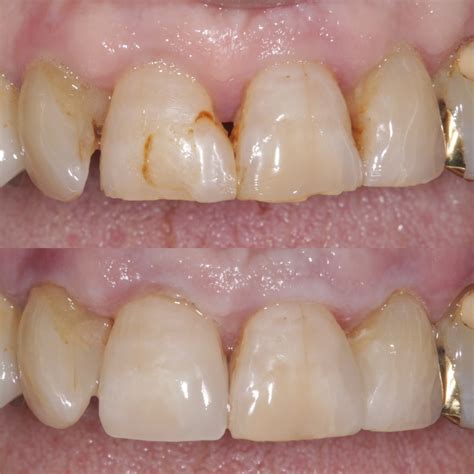 How To Remove Old Composite Filling