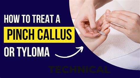 How To Remove Pinch Callus