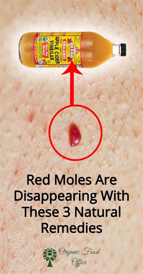how to remove red moles on skin