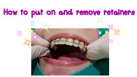 How To Remove Retainer Easily