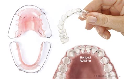 How To Remove Retainers Properly