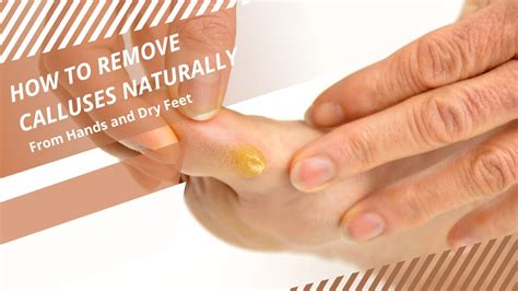 How To Remove Stubborn Calluses