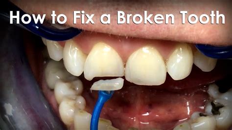 how to repair broken tooth