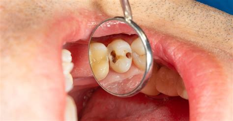 how to replace decayed teeth