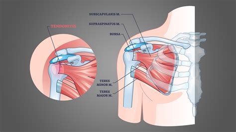 How To Rest Shoulder Tendonitis