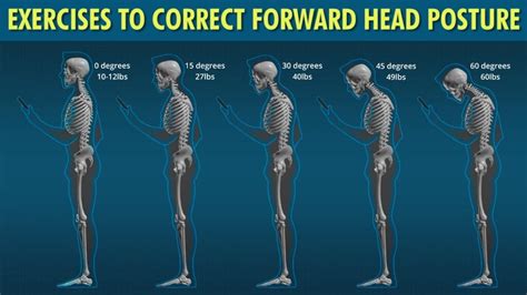 how to reverse forward head posture