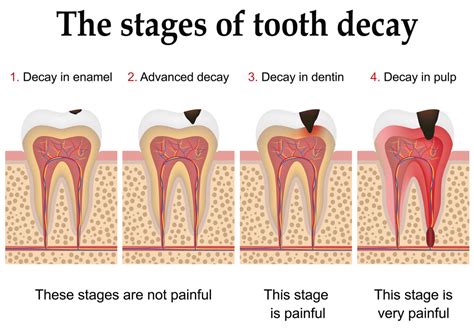how to reverse hole in tooth