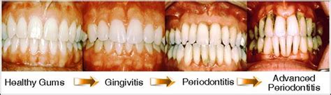 how to reverse periodontal disease