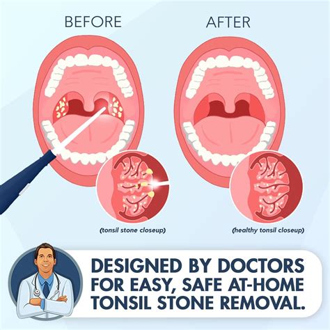 how to rid tonsil stones