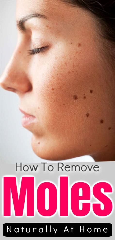 how to safely remove moles at home