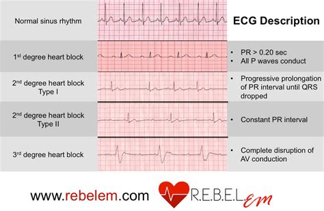 how to see heart block on ecg