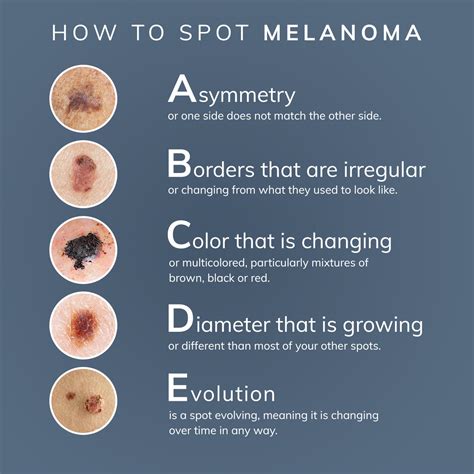 how to spot a melanoma