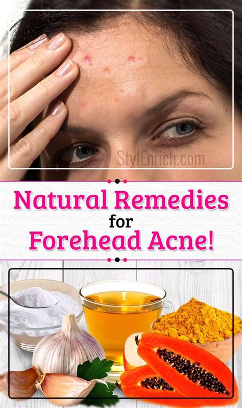 How to Stop Forehead Acne – Effective Tips and Strategies