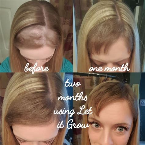 How To Stop Hair Fall After Childbirth  Tips  Faqs  And Hair Care