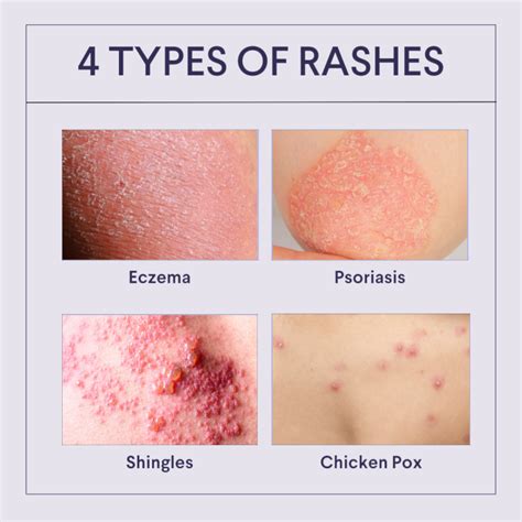 how to stop rash from spreading