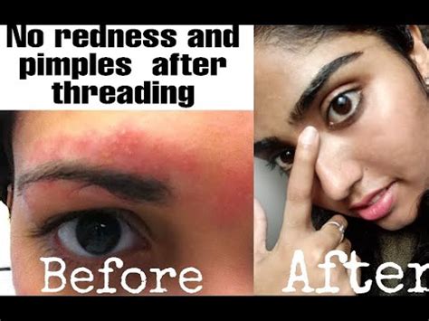 How To Stop Redness After Threading